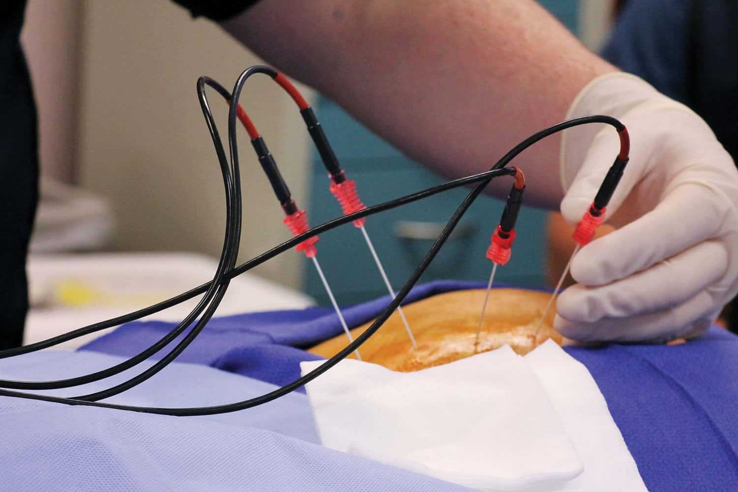 A vein treatment using heat from radio waves