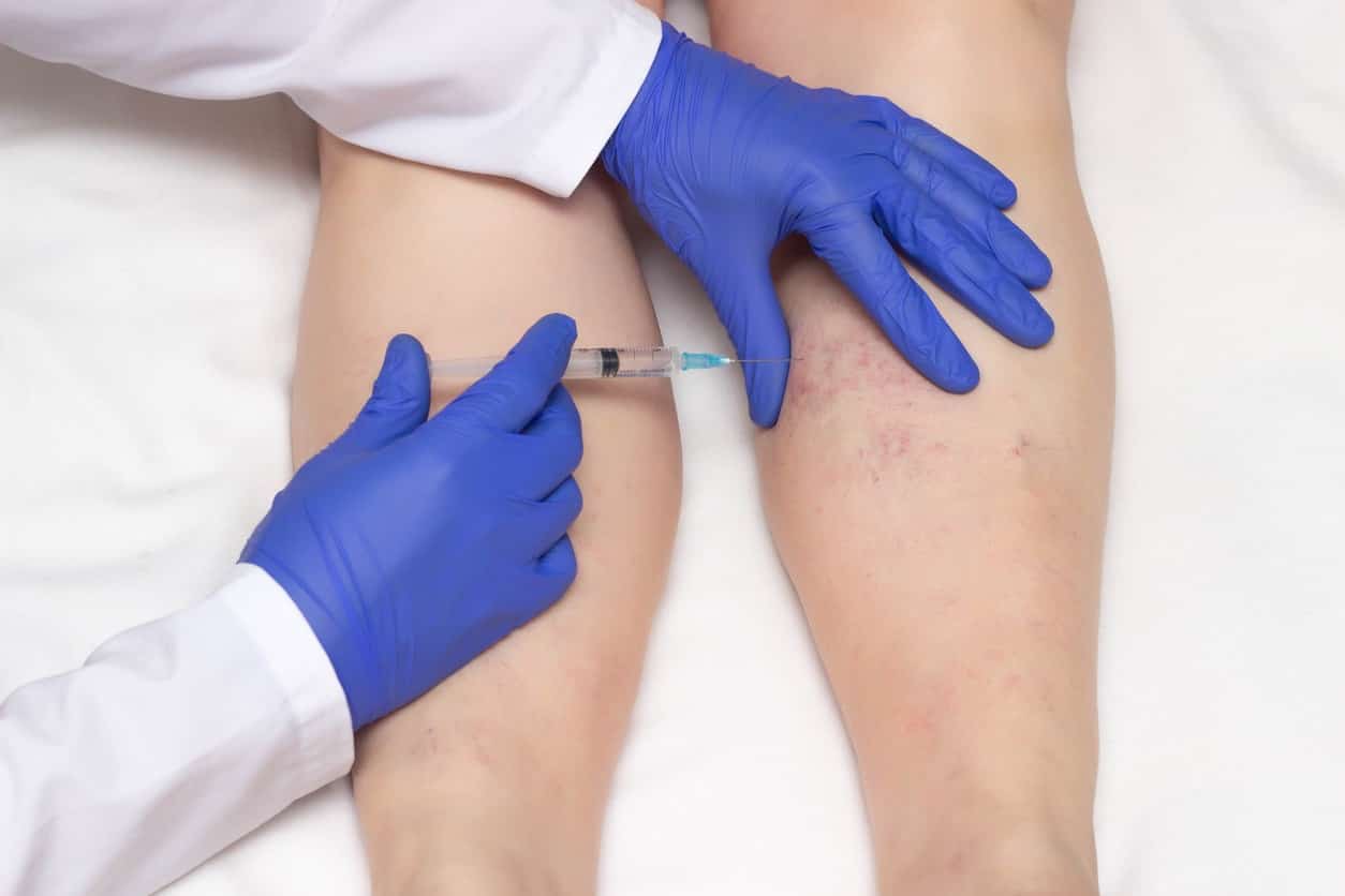 A vein treatment using an injectable medicine