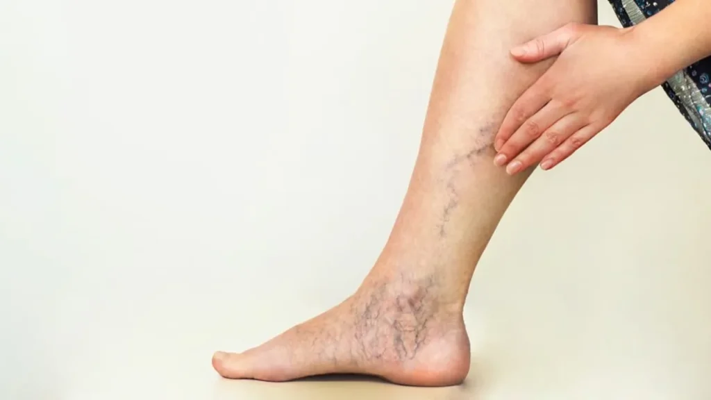 Varicose Veins